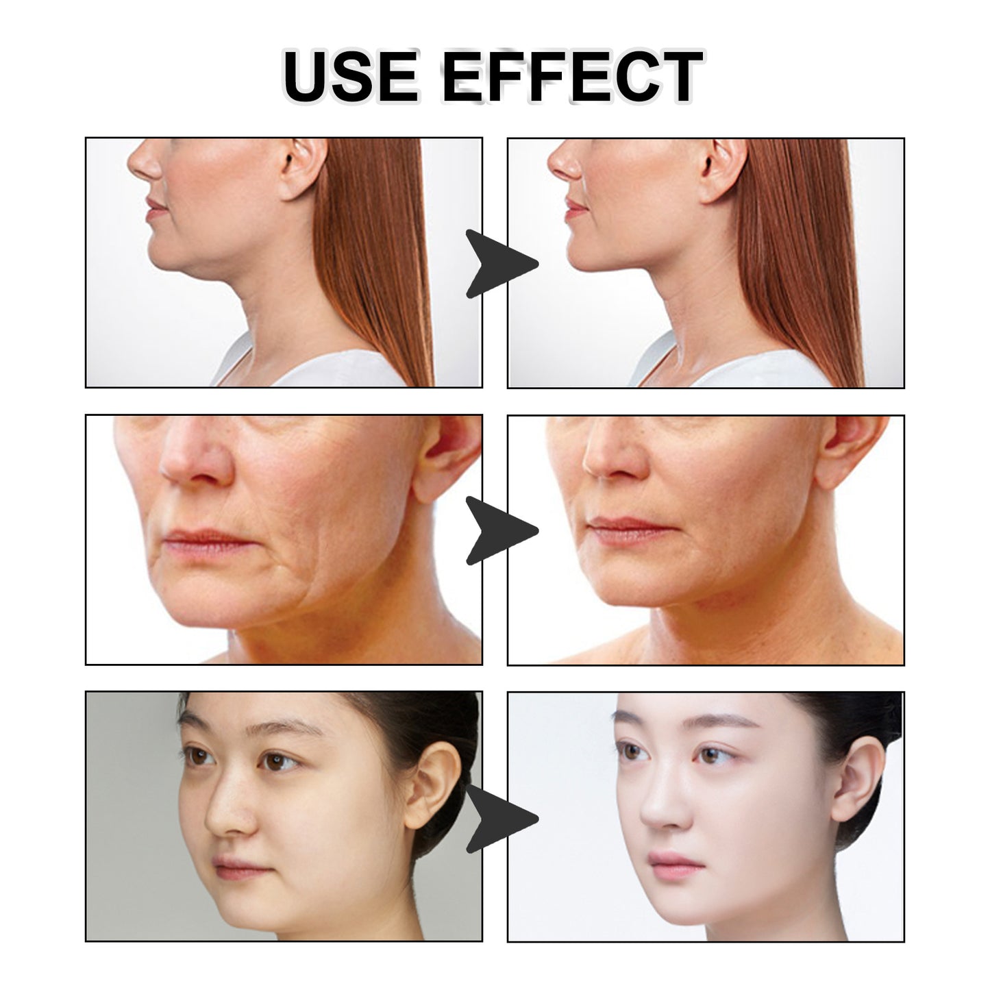 SculptEase™Cintas faciales lifting
