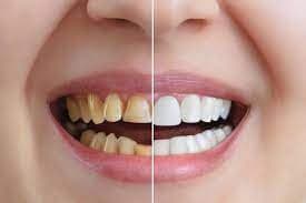 CARILLAS DENTALES-SNAPON SMILE